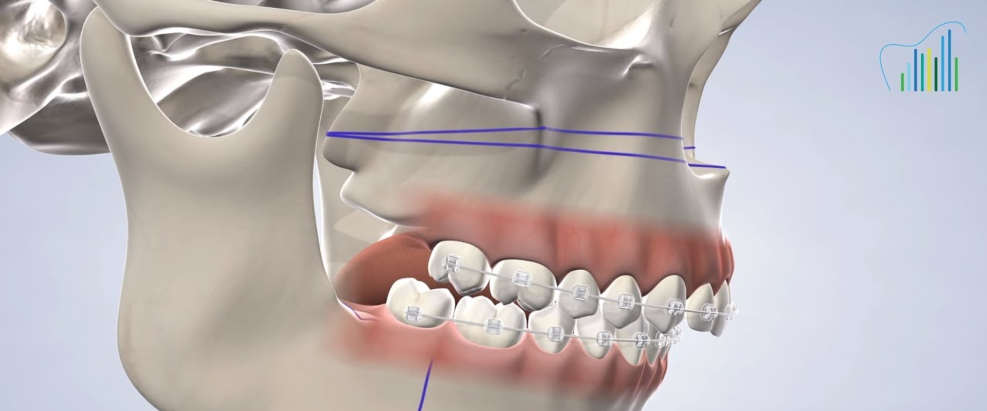 Teeth Implants Technology - Astra Tech