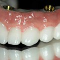 Can I Get a Crown with a Single Dental Implant?