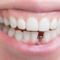Everything You Need to Know About Tooth Implants
