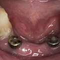 Can I Get a Dental Implant After a Tooth Extraction?
