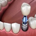 Recovery Time for Teeth Implants: What to Expect