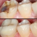 Should You Save a Tooth or Get an Implant?