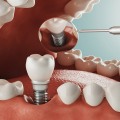 Alternatives to Teeth Implants: What Are Your Options?