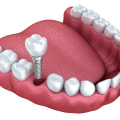 The Cost of Teeth Implants: An Investment Worth Making