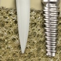Teeth Implants On Main Street: A Comprehensive Guide To Dental Implant Advancements