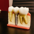 San Antonio's Restorative Dentistry Revolution: How Teeth Implants Are Changing Lives