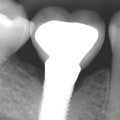 What is the Gap between Implant Crown and Tooth?