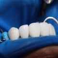 Transform Your Smile The Benefits Of Teeth Implants In Arvada, CO