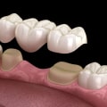 Experience The Transformation: Dental Implants In Spring Branch