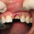 How Long Does it Take to Get Teeth Implants?