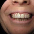 How Long Should You Wait Between Dental Implant and Crown Placement?