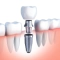 Why are Dental Implants So Unaffordable?