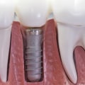 Can I Get a Dental Implant After Root Canal Treatment?