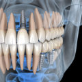 Smile Confidently: All About Teeth Implants In Conroe, TX