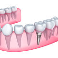 Can You Get Dental Implants After Tooth Extraction?