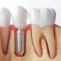 Success Rate of Teeth Implants: What You Need to Know
