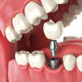 Can I Get a Dental Implant Crown Replacement?