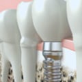 Are Dental Implants Safe for MRI?