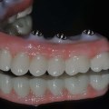 What is the Best Material for Teeth Implants?