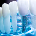 The Benefits Of Dental Implants: How Teeth Implants Can Improve Your Chewing Ability And Boost Your Confidence In Waco, TX