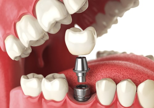 Are Dental Implants Safe? What Are the Contraindications?