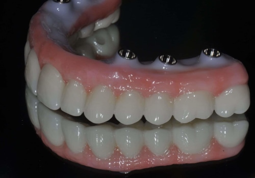 What Materials are Used for Teeth Implants?