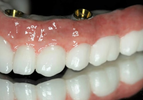 Can I Get a Crown with a Single Dental Implant?