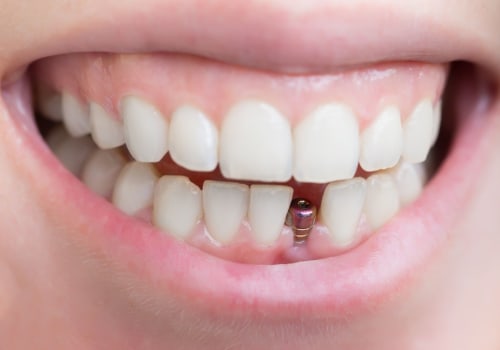 Everything You Need to Know About Tooth Implants