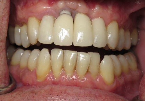 When is Dental Implant Not Possible?