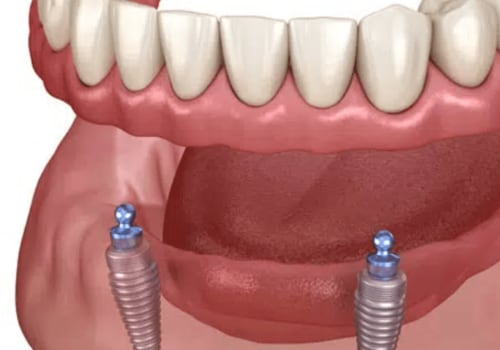 Say Goodbye To Missing Teeth: How Dental Implants Can Transform Your Smile In Cedar Park, TX