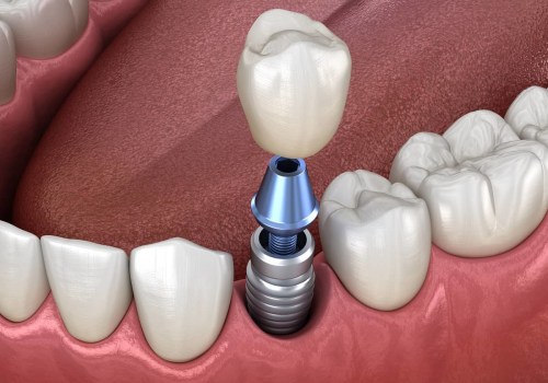 Recovery Time for Teeth Implants: What to Expect