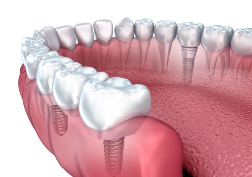 What Materials are Tooth Implants Made Of?