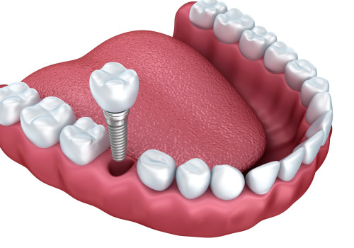 The Cost of Teeth Implants: An Investment Worth Making