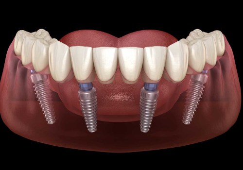 Can Heart Patients Get Dental Implants Safely?