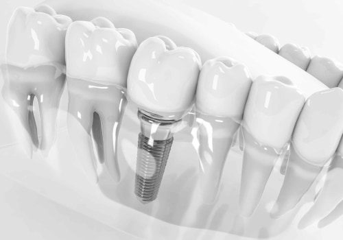Transform Your Smile With The Best Dentist In Aurora South And Exceptional Teeth Implants