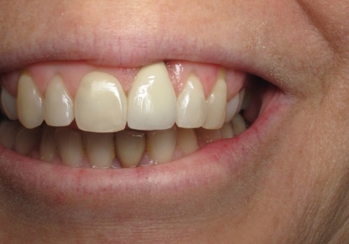 The Road To A Perfect Smile: All About Teeth Implants In Austin, TX