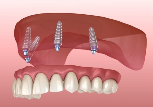 Do Dental Implants Need Regular Adjustments After Placement?