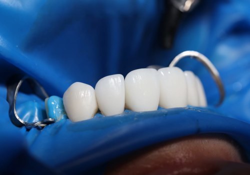 Transform Your Smile The Benefits Of Teeth Implants In Arvada, CO