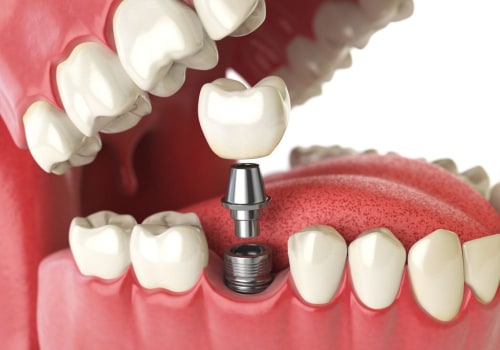 What is the Average Cost of Dental Implants in the US?