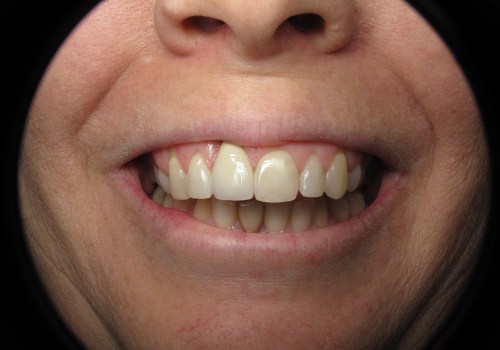 How Long Should You Wait Between Dental Implant and Crown Placement?