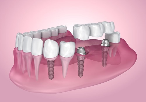 Are Dental Implants the Right Choice for Everyone?