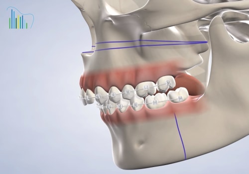 Can I Get a Dental Implant After Jaw Surgery or Trauma?