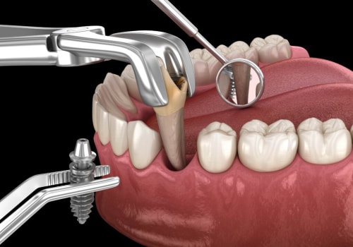 Should You Get an Implant After Tooth Extraction?