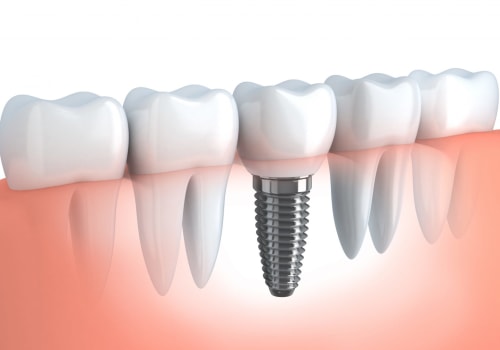 Do Dental Implants Require Regular Check-Ups After Placement?