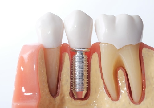 Success Rate of Teeth Implants: What You Need to Know